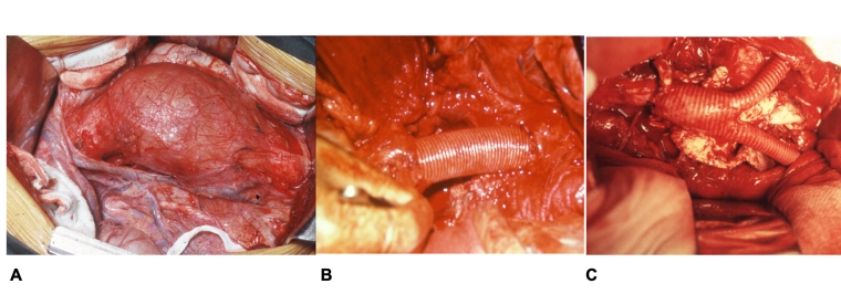 Abdominal aortic aneurysms how to treat in today s practice